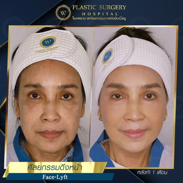 ดึงหน้า