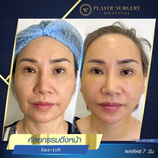 ดึงหน้า