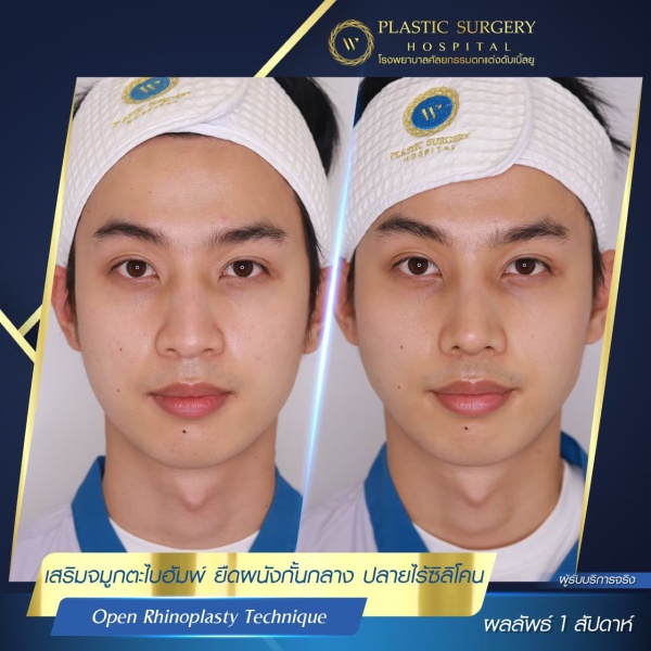 เสริมจมูก