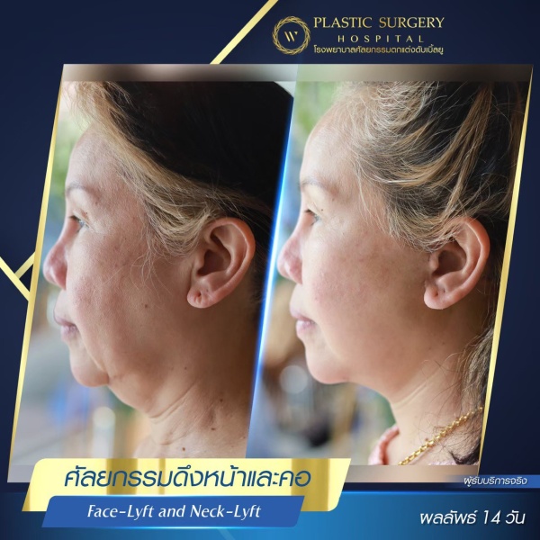 ดึงหน้า