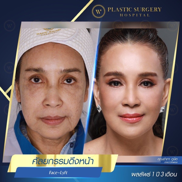 ดึงหน้า