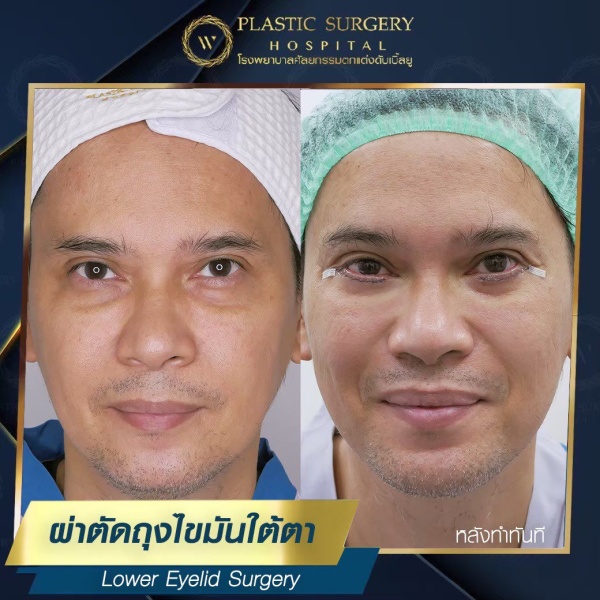 ตัดถุงไขมันใต้ตา
