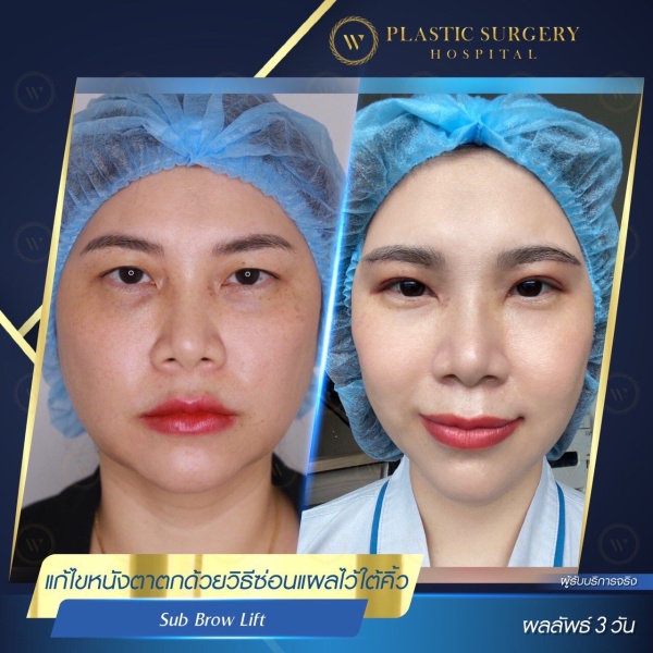 หนังตา/หางตาบนตก