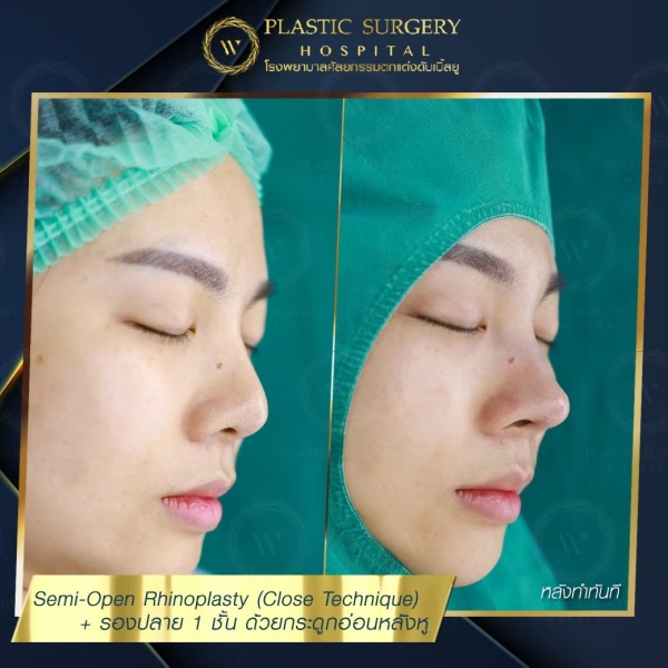 เสริมจมูก