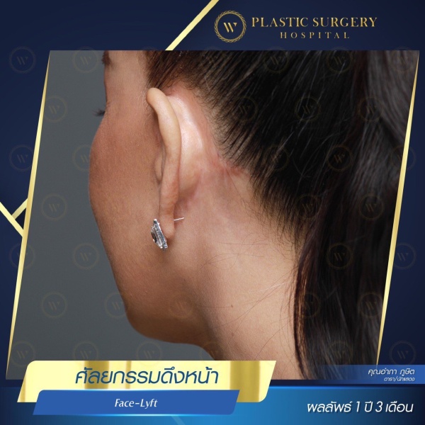 ดึงหน้า