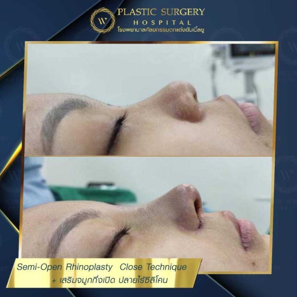 เสริมจมูก