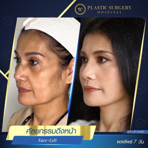 ดึงหน้า