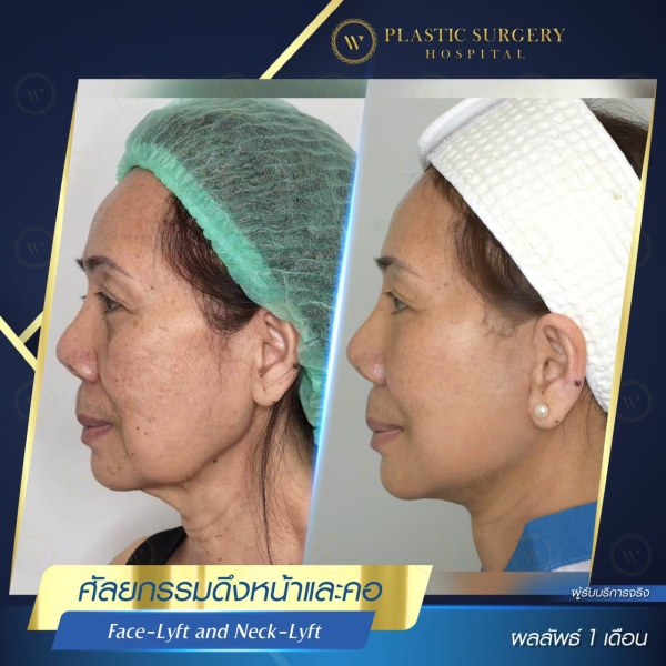 ดึงหน้า