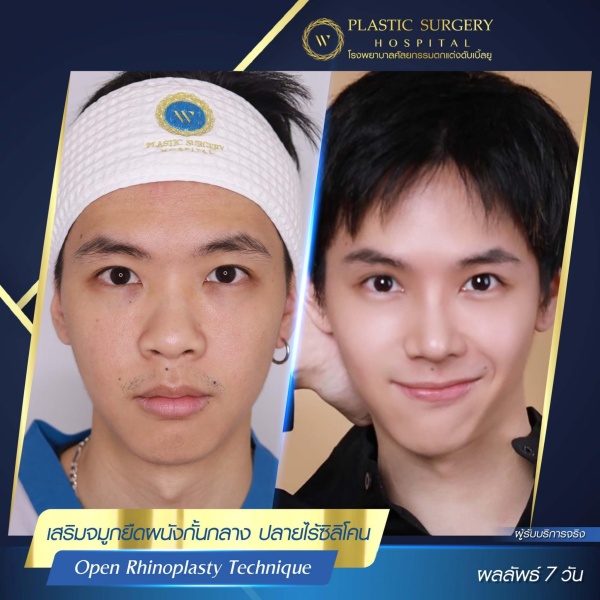 เสริมจมูก