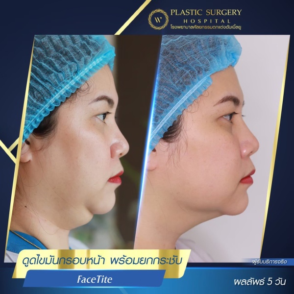 ดูดไขมันเหนียงใต้คาง (FaceTite)