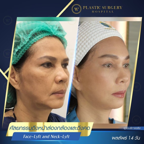 ดึงหน้า