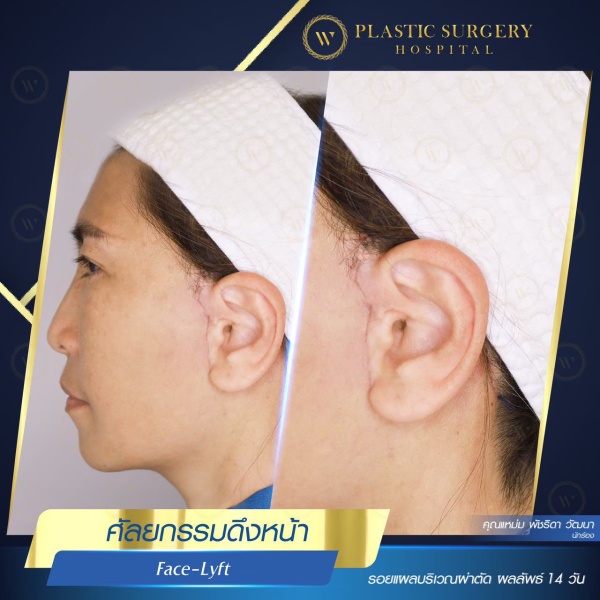 ดึงหน้า