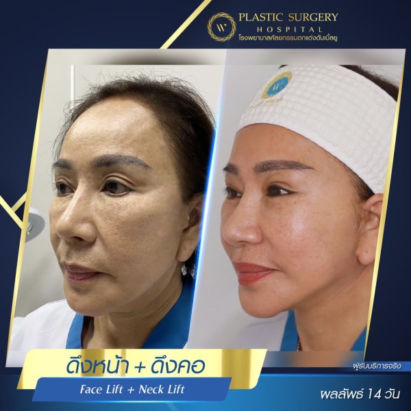 ดึงหน้า