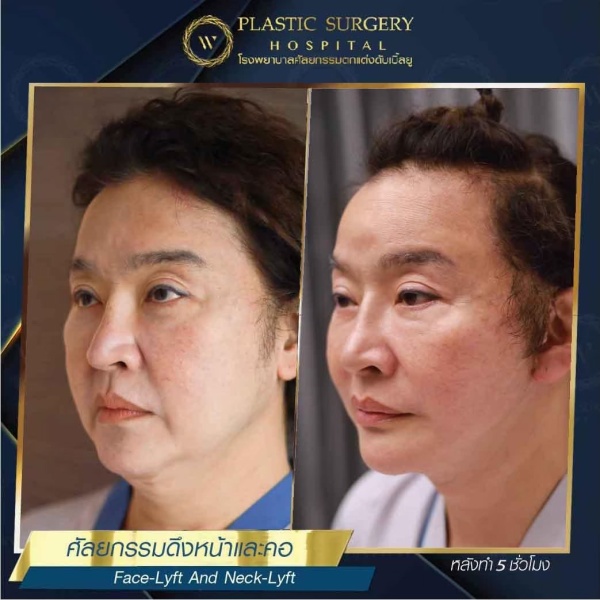 ดึงหน้า