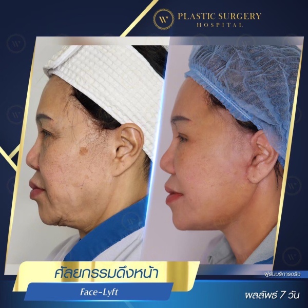 ดึงหน้า