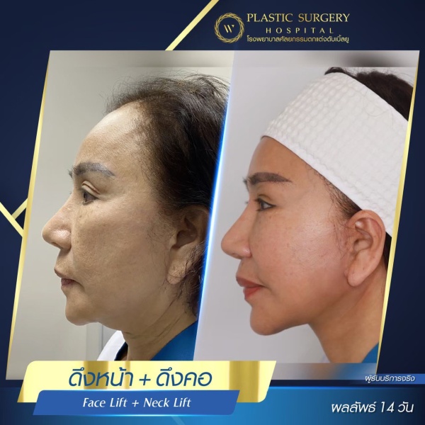 ดึงหน้า