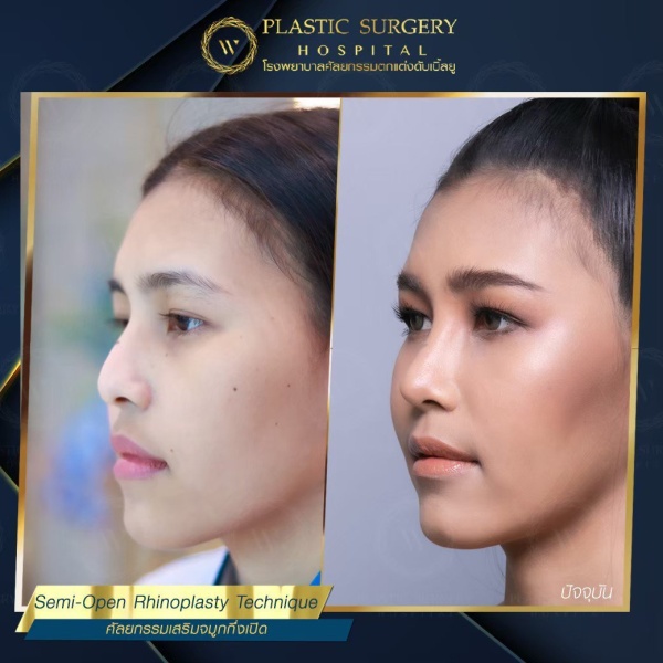 เสริมจมูก