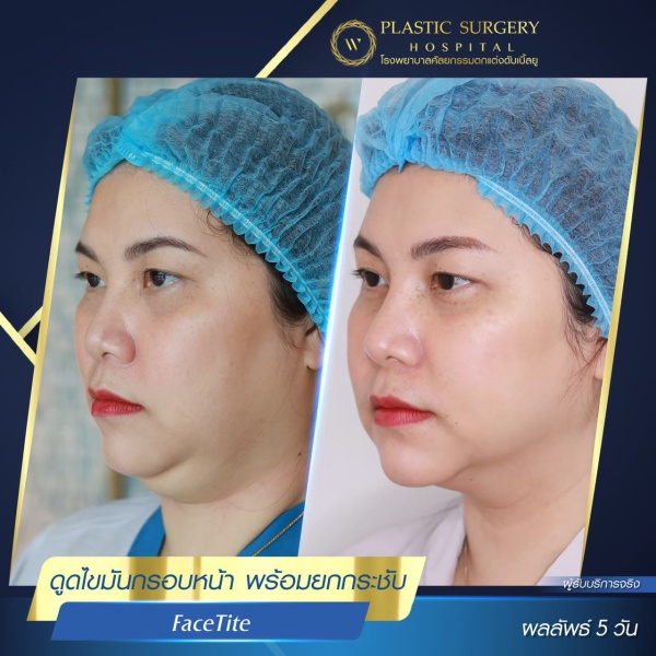 ดูดไขมันเหนียงใต้คาง (FaceTite)
