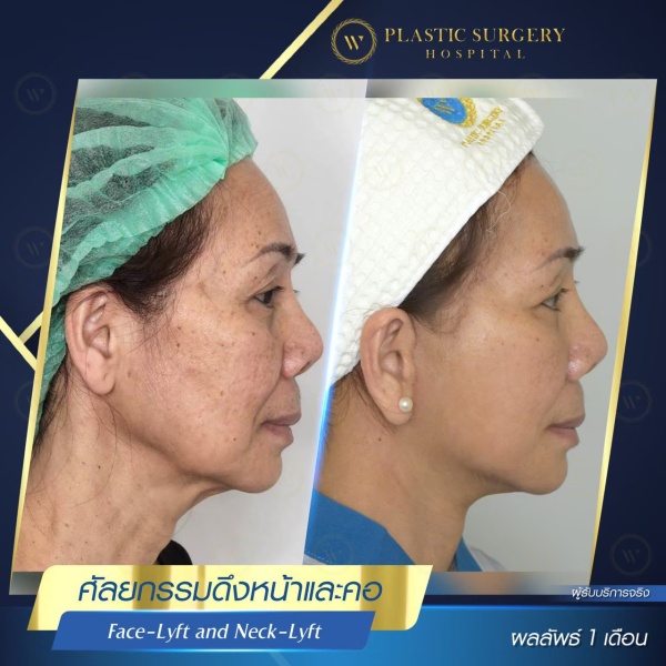 ดึงหน้า