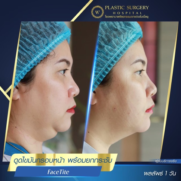 ดูดไขมันเหนียงใต้คาง (FaceTite)