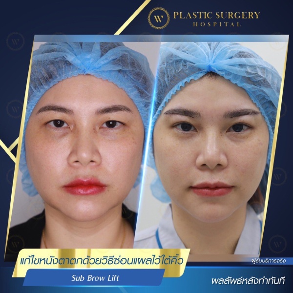 หนังตา/หางตาบนตก