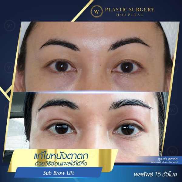 หนังตา/หางตาบนตก