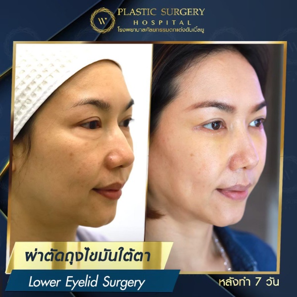 ตัดถุงไขมันใต้ตา