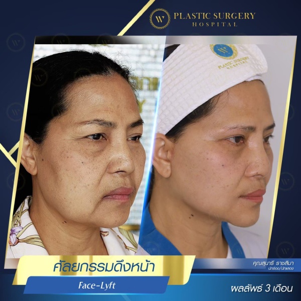 ดึงหน้า