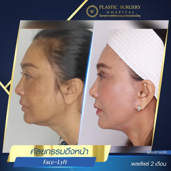 ดึงหน้า