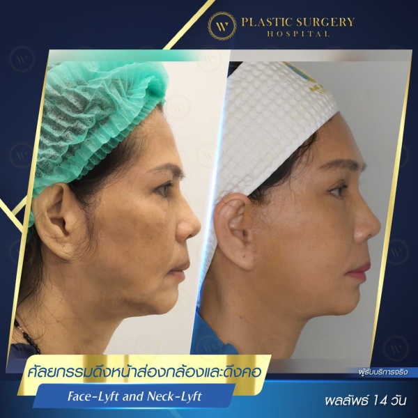 ดึงหน้า