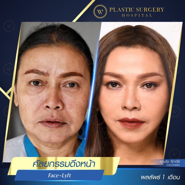 ดึงหน้า