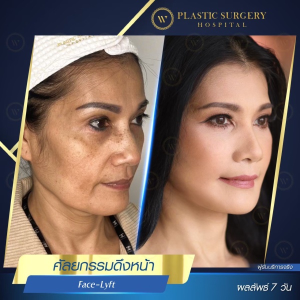 ดึงหน้า