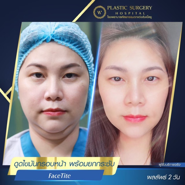 ดูดไขมันเหนียงใต้คาง (FaceTite)