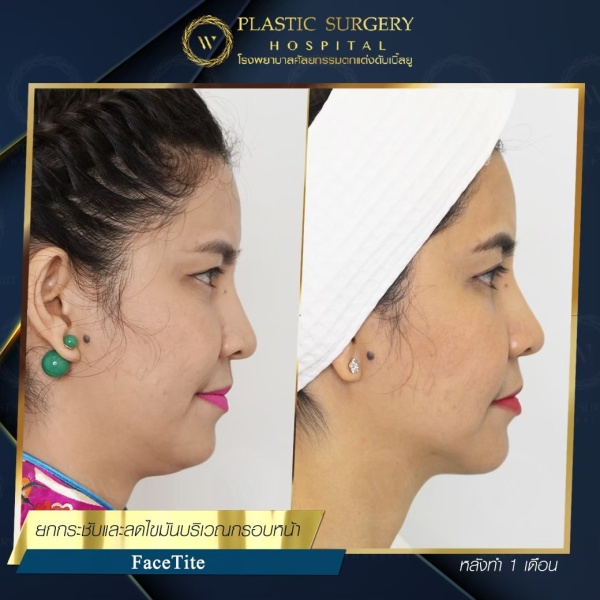 ดูดไขมันเหนียงใต้คาง (FaceTite)