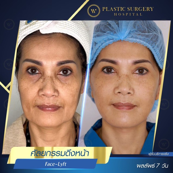 ดึงหน้า