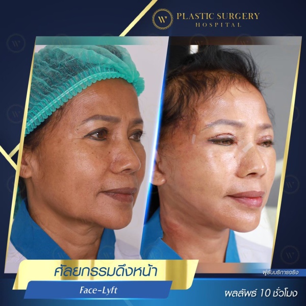 ดึงหน้า