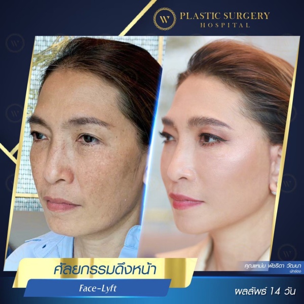 ดึงหน้า