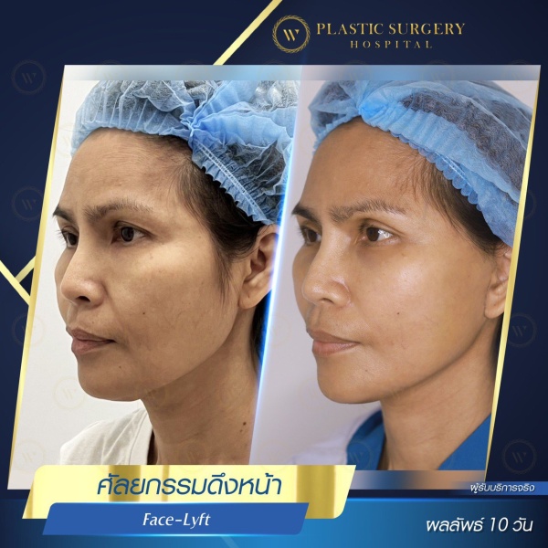 ดึงหน้า