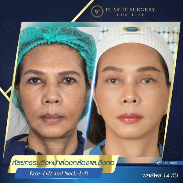 ดึงหน้า