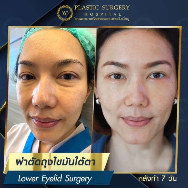 ตัดถุงไขมันใต้ตา
