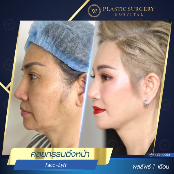 ดึงหน้า