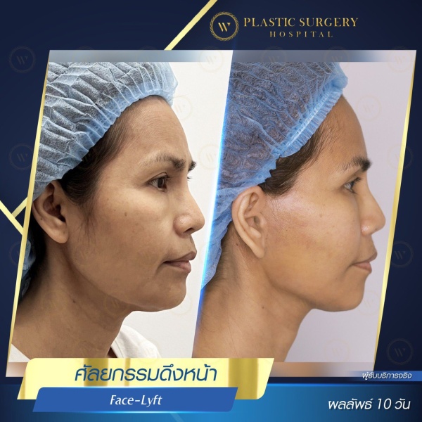 ดึงหน้า