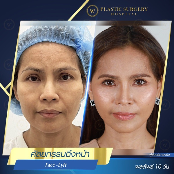 ดึงหน้า