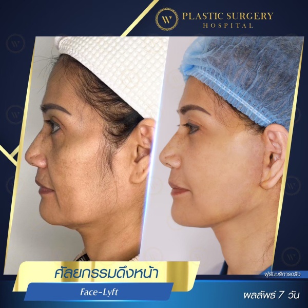 ดึงหน้า