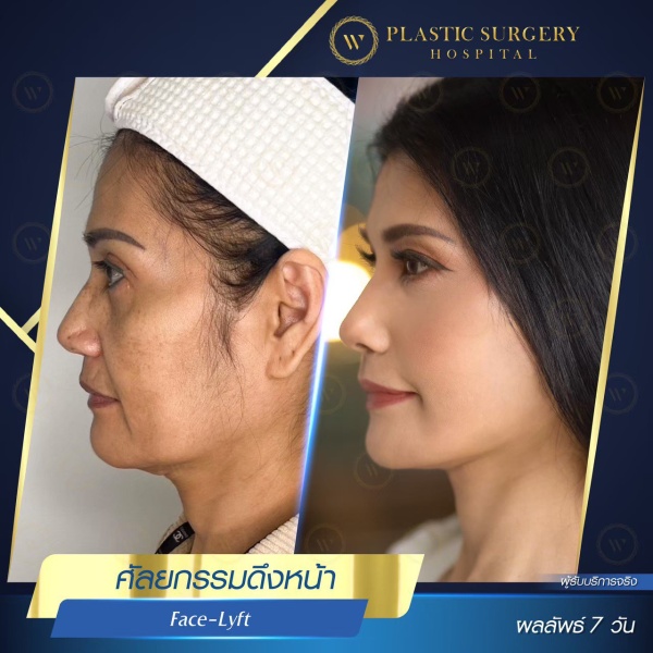 ดึงหน้า