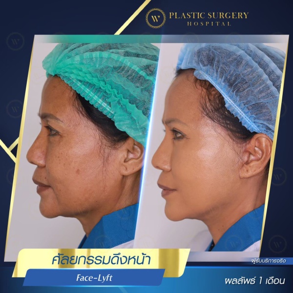 ดึงหน้า