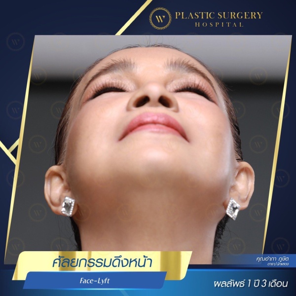 ดึงหน้า