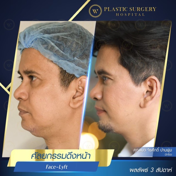 ดึงหน้า