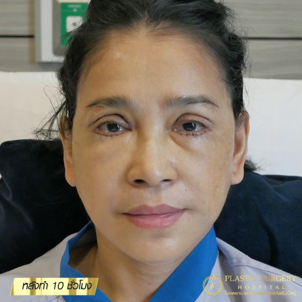 ดึงหน้า