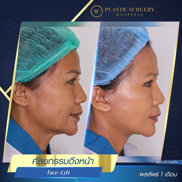 ดึงหน้า